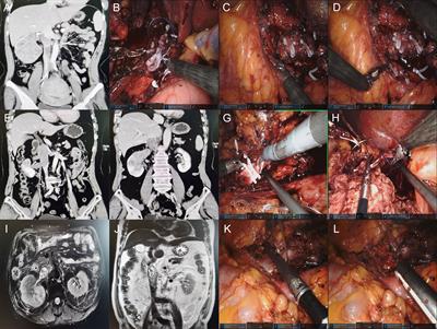 Robot-Assisted Laparoscopic IVC Treatment Strategy in Retroperitoneal Tumors